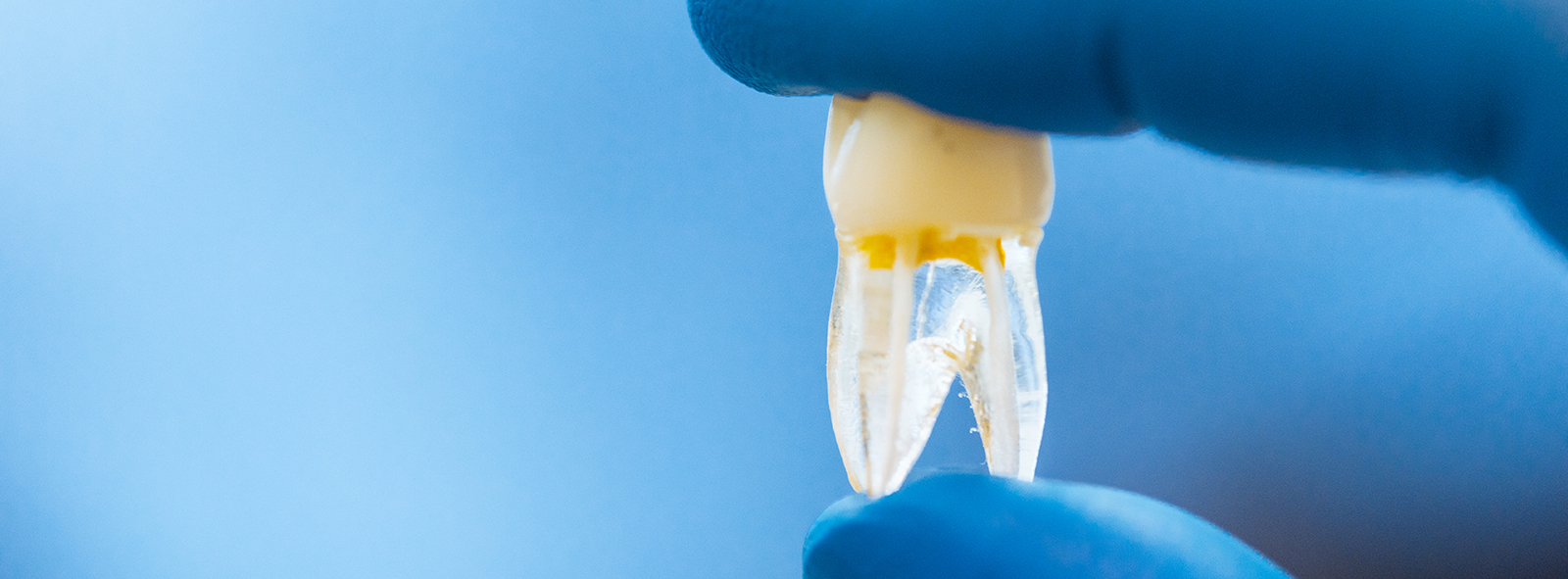 Tooth extraction in Simi Valley